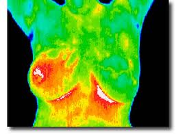 Mammography vs. Thermography: Which Is Better at Detecting 